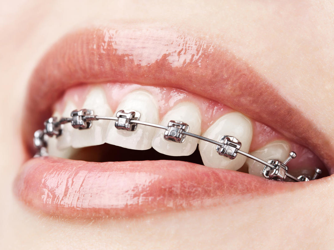Ortodoncia correctiva con bracket convencionales y cerámicos